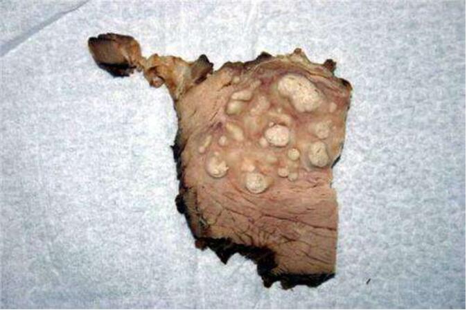 猪肉绦虫能高温多少度能杀死，猪肉绦虫是怎么感染上的？