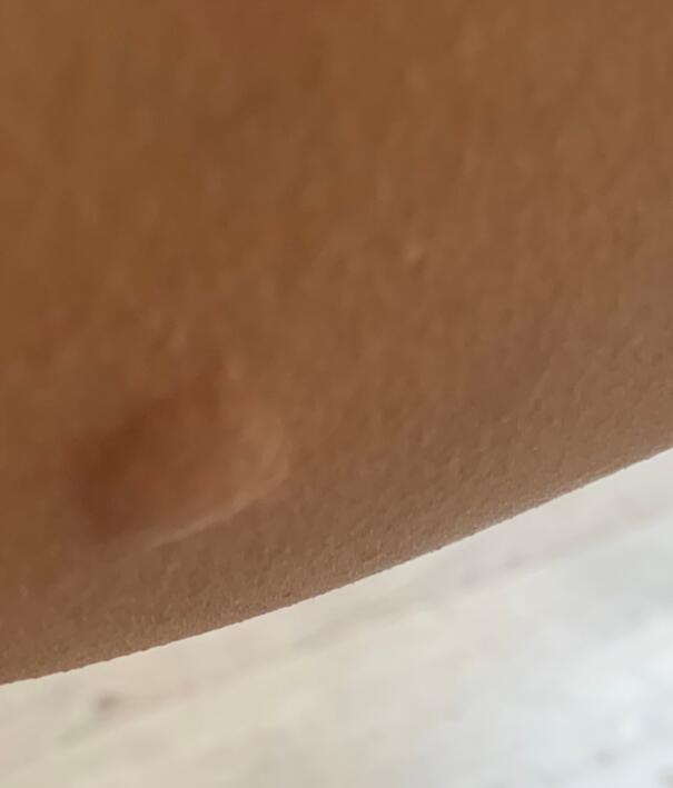 被白纹伊蚊咬了是怎么样的图片，它的幼虫是什么样的？
