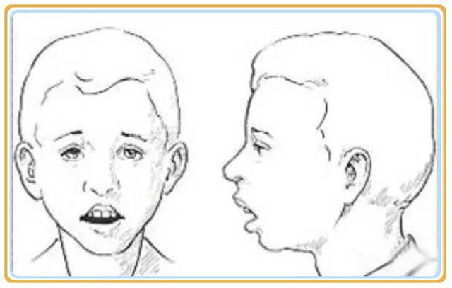 口呼吸面容的经典样子图片，张嘴呼吸变丑能恢复吗？
