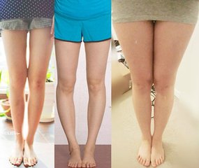 o型腿和x型腿真人图，o型腿和x型腿的体操矫正法