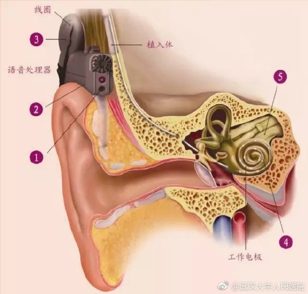 戴人工耳蜗小孩怎么洗头，人工耳蜗要戴一辈子吗？