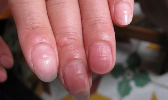 指甲上有竖纹是癌症预兆吗？那种指甲黑线代表癌症