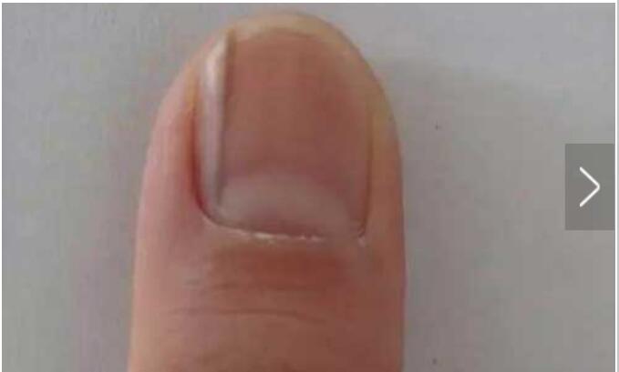 指甲上有竖纹是有病说法准确吗，不健康人的指甲图片