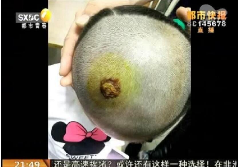 蜱虫咬人后有什么症状，蜱虫咬人的伤口图片